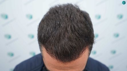Injerto Capilar Técnica FUE Grafts 2945 (6960 Pelos) 34 33AB RESULTADOS A LOS 12 MESES