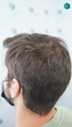 Injerto Capilar Técnica FUE Grafts 2117 (5025 Pelos) 45 34 RESULTADOS A LOS 12 MESES 1