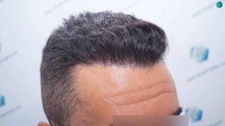 Injerto Capilar Técnica FUE Grafts 2945 (6960 Pelos) 35 34 RESULTADOS A LOS 12 MESES 2