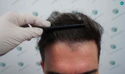 34 RESULTADOS A LOS 12 MESES