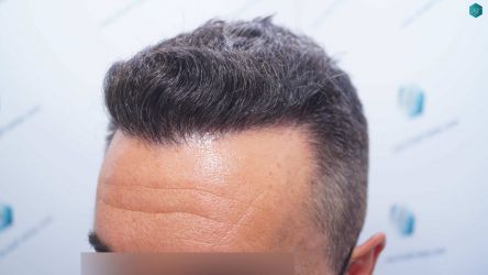 Injerto Capilar Técnica FUE Grafts 2945 (6960 Pelos) 36 35 RESULTADOS A LOS 12 MESES 2