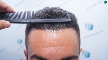 Injerto Capilar Técnica FUE Grafts 2945 (6960 Pelos) 37 36 RESULTADOS A LOS 12 MESES 1