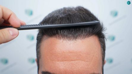 Injerto Capilar Técnica FUE Grafts 2945 (6960 Pelos) 38 36A RESULTADOS A LOS 12 MESES