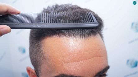 Injerto Capilar Técnica FUE Grafts 2945 (6960 Pelos) 39 37 RESULTADOS A LOS 12 MESES 1