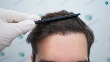 Injerto Capilar Técnica FUE Grafts 2117 (5025 Pelos) 48 37 RESULTADOS A LOS 12 MESES