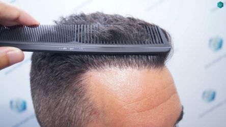 Injerto Capilar Técnica FUE Grafts 2945 (6960 Pelos) 40 37A RESULTADOS A LOS 12 MESES