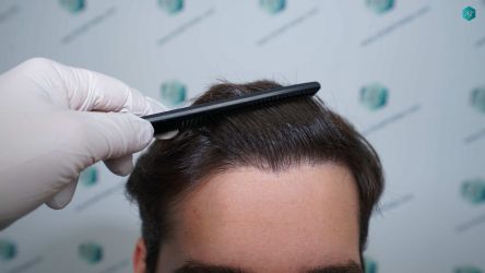 Injerto Capilar Técnica FUE Grafts 2117 (5025 Pelos) 49 38 RESULTADOS A LOS 12 MESES 1