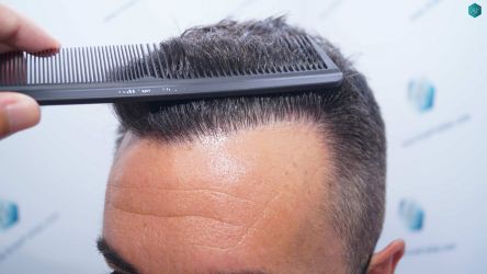 Injerto Capilar Técnica FUE Grafts 2945 (6960 Pelos) 41 38 RESULTADOS A LOS 12 MESES 2