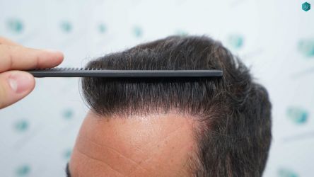 Injerto Capilar Técnica FUE Grafts 2945 (6960 Pelos) 42 39 RESULTADOS A LOS 12 MESES 1
