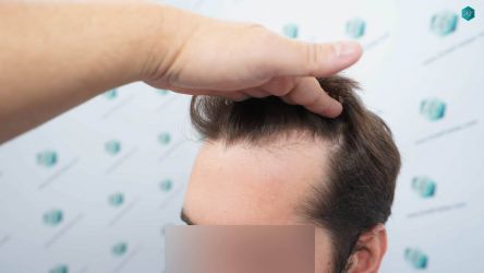 Injerto Capilar Técnica FUE Grafts 2117 (5025 Pelos) 3 4 ANTES DEL TRASPLANTE CAPILAR 1