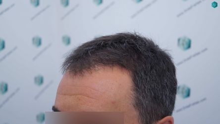 Injerto Capilar Técnica FUE Grafts 2945 (6960 Pelos) 5 4 ANTES DEL TRASPLANTE CAPILAR 2