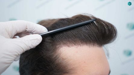 Injerto Capilar Técnica FUE Grafts 2117 (5025 Pelos) 50 40 RESULTADOS A LOS 12 MESES 1