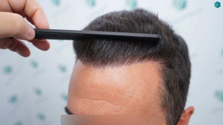 Injerto Capilar Técnica FUE Grafts 2945 (6960 Pelos) 43 41 RESULTADOS A LOS 12 MESES