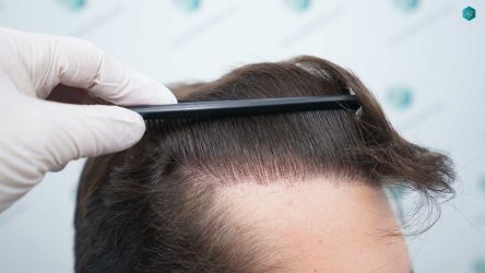 Injerto Capilar Técnica FUE Grafts 2117 (5025 Pelos) 51 42 RESULTADOS A LOS 12 MESES 1