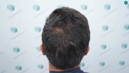 Injerto Capilar Técnica FUE Grafts 2945 (6960 Pelos) 44 42 RESULTADOS A LOS 12 MESES 2