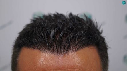 Injerto Capilar Técnica FUE Grafts 2945 (6960 Pelos) 45 42A RESULTADOS A LOS 12 MESES 1