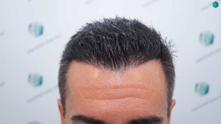 Injerto Capilar Técnica FUE Grafts 2945 (6960 Pelos) 46 42AB RESULTADOS A LOS 12 MESES 1