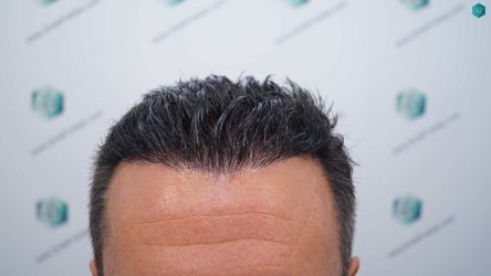 Injerto Capilar Técnica FUE Grafts 2945 (6960 Pelos) 47 43AB RESULTADOS A LOS 12 MESES