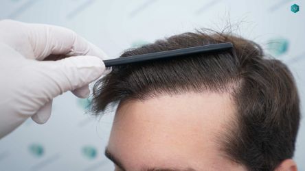 Injerto Capilar Técnica FUE Grafts 2117 (5025 Pelos) 53 44 RESULTADOS A LOS 12 MESES