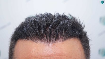 Injerto Capilar Técnica FUE Grafts 2945 (6960 Pelos) 48 44A RESULTADOS A LOS 12 MESES