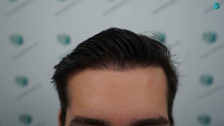 Injerto Capilar Técnica FUE Grafts 2117 (5025 Pelos) 54 45 RESULTADOS A LOS 12 MESES 1