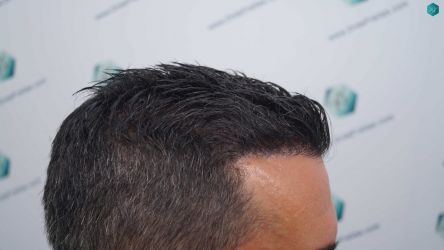 Injerto Capilar Técnica FUE Grafts 2945 (6960 Pelos) 49 45 RESULTADOS A LOS 12 MESES 2