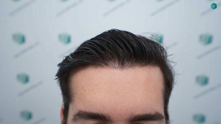 Injerto Capilar Técnica FUE Grafts 2117 (5025 Pelos) 55 46 RESULTADOS A LOS 12 MESES 1