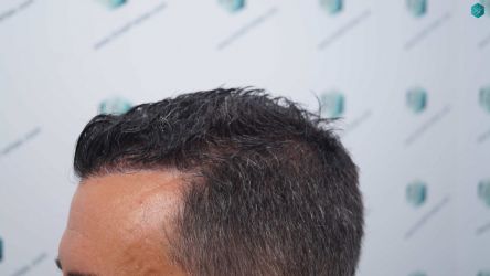 Injerto Capilar Técnica FUE Grafts 2945 (6960 Pelos) 50 46 RESULTADOS A LOS 12 MESES 2