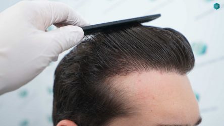 Injerto Capilar Técnica FUE Grafts 2117 (5025 Pelos) 56 46B RESULTADOS A LOS 12 MESES