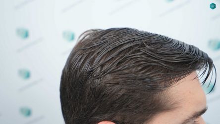 Injerto Capilar Técnica FUE Grafts 2117 (5025 Pelos) 57 47 RESULTADOS A LOS 12 MESES 1