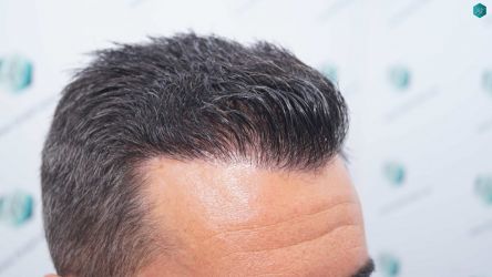 Injerto Capilar Técnica FUE Grafts 2945 (6960 Pelos) 51 47 RESULTADOS A LOS 12 MESES 2