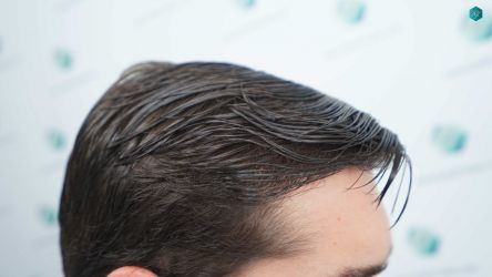 Injerto Capilar Técnica FUE Grafts 2117 (5025 Pelos) 58 48 RESULTADOS A LOS 12 MESES 1