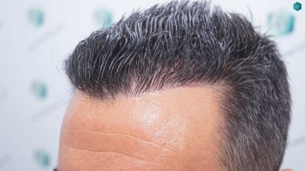 Injerto Capilar Técnica FUE Grafts 2945 (6960 Pelos) 52 48 RESULTADOS A LOS 12 MESES 2