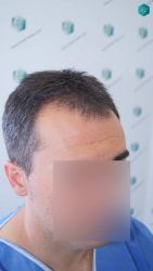 Injerto Capilar Técnica FUE Grafts 2945 (6960 Pelos) 3 5 ANTES DEL TRASPLANTE CAPILAR 1