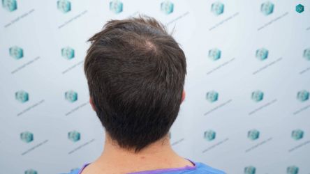 Injerto Capilar Técnica FUE Grafts 2117 (5025 Pelos) 4 5 ANTES DEL TRASPLANTE CAPILAR