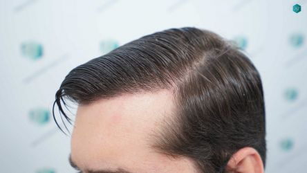 Injerto Capilar Técnica FUE Grafts 2117 (5025 Pelos) 60 50 RESULTADOS A LOS 12 MESES