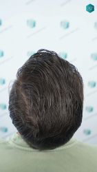 Injerto Capilar Técnica FUE Grafts 2117 (5025 Pelos) 62 52 RESULTADOS A LOS 12 MESES