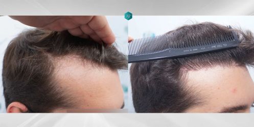 Injerto Capilar Técnica FUE Grafts 2117 (5025 Pelos) 63 54 COMPARATIVAS.