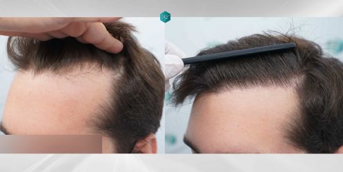 Injerto Capilar Técnica FUE Grafts 2117 (5025 Pelos) 64 55 COMPARATIVAS.