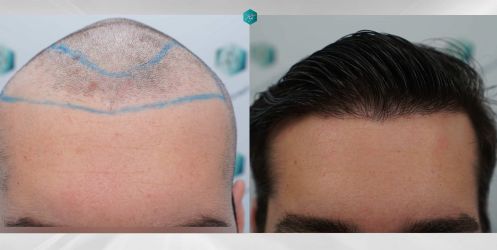 Injerto Capilar Técnica FUE Grafts 2117 (5025 Pelos) 65 56 COMPARATIVAS.