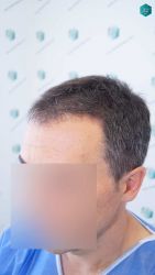 Injerto Capilar Técnica FUE Grafts 2945 (6960 Pelos) 4 6 ANTES DEL TRASPLANTE CAPILAR 1