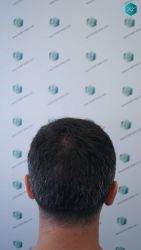 Injerto Capilar Técnica FUE Grafts 2945 (6960 Pelos) 6 7 ANTES DEL TRASPLANTE CAPILAR 1