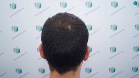 7 ANTES DEL TRASPLANTE CAPILAR