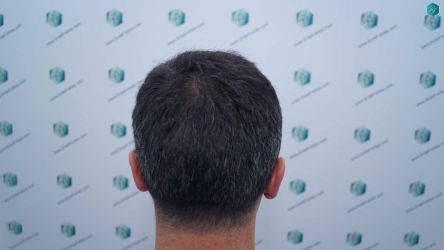Injerto Capilar Técnica FUE Grafts 2945 (6960 Pelos) 7 8 ANTES DEL TRASPLANTE CAPILAR