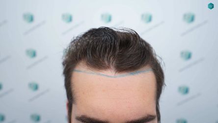 Injerto Capilar Técnica FUE Grafts 2117 (5025 Pelos) 6 8 LINEA DISENO INJERTO