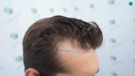 Injerto Capilar Técnica FUE Grafts 2117 (5025 Pelos) 7 9 LINEA DISENO INJERTO