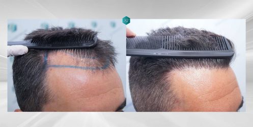 Injerto Capilar Técnica FUE Grafts 2945 (6960 Pelos) 53 COMPARATIVA 2