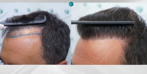 Injerto Capilar Técnica FUE Grafts 2945 (6960 Pelos) 54 COMPARATIVA 3