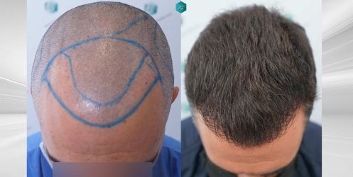 Injerto Capilar Técnica FUE Grafts 2945 (6960 Pelos) 55 COMPARATIVA 4
