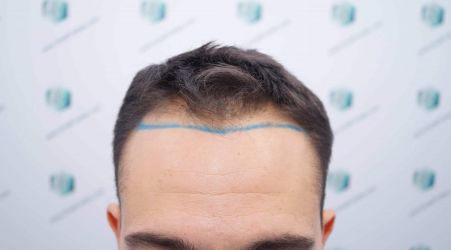 Injerto Capilar Técnica FUE Grafts 2314 (5722 Pelos) 7 11 DISENO LINEA DE INJERTO CAPILAR